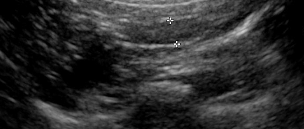 ultrasonography